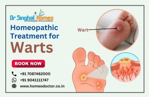 Get the Best Homeopathic Treatment for Warts in India?